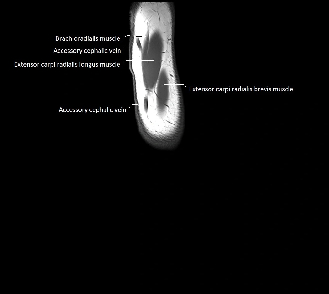 MRI 3T forearm sagittal labelled cross sectional anatomy image 3.webp